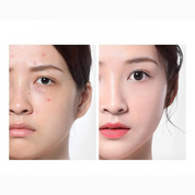 Clearskin Ampulle Toner - Akne -Pflege und feuchtigkeitsspendendes Serum-3