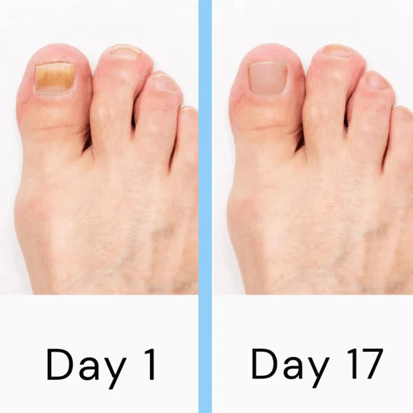 Nagellaserpilzgerät 3