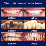 Plaquefree Plaque Remover für Zähne | Ultraschallzählerreiniger - Tartarentferner von zu Hause - Tiefenzähne Reinigung und Politur 2