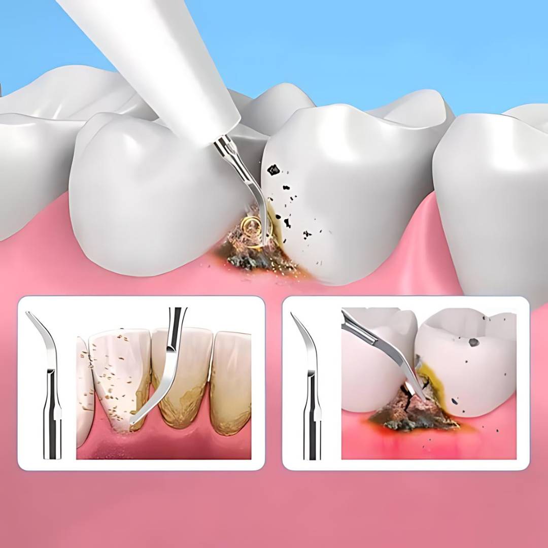 Plaquefree Plaque Remover für Zähne | Ultraschallzählerreiniger - Tartarentferner von zu Hause - Tiefenzähne Reinigung und Politur 4