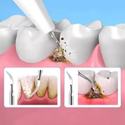 Plaquefree Plaque Remover für Zähne | Ultraschallzählerreiniger - Tartarentferner von zu Hause - Tiefenzähne Reinigung und Politur 4
