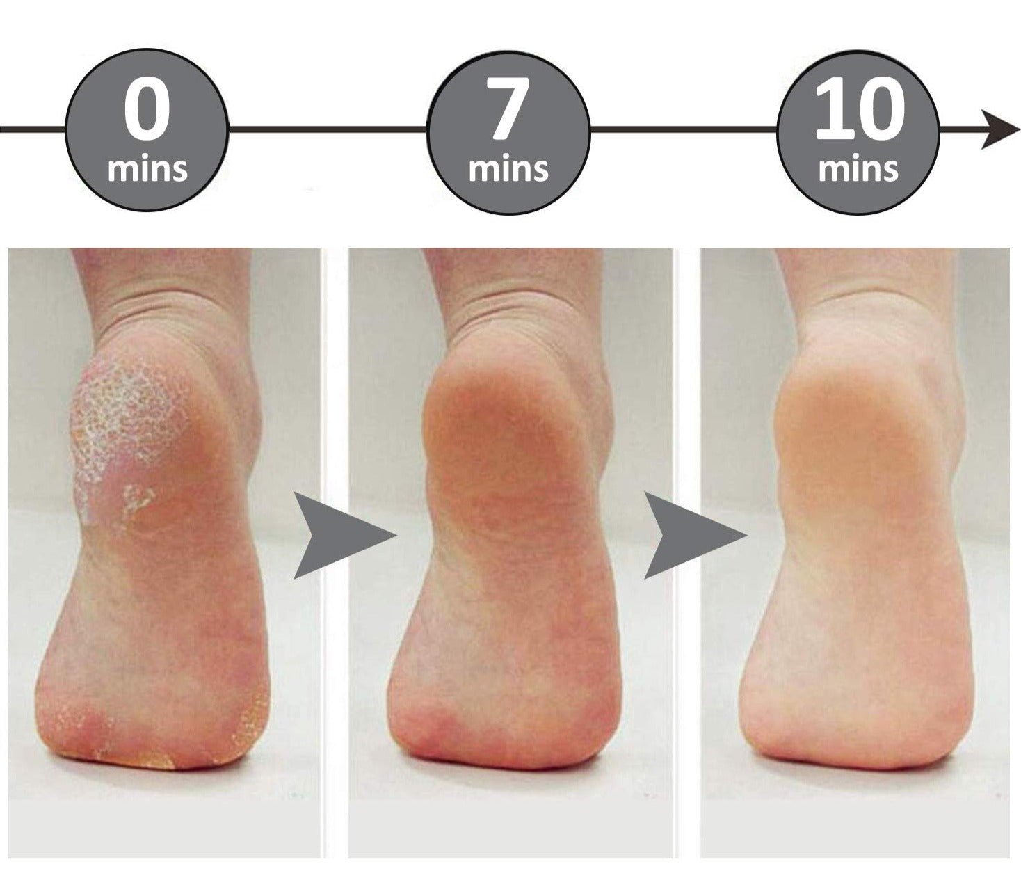 Mevor | Callus Removers - kompakt und sicher - schmerzlose Genesung-3