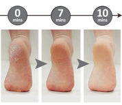 Mevor | Callus Removers - kompakt und sicher - schmerzlose Genesung-3