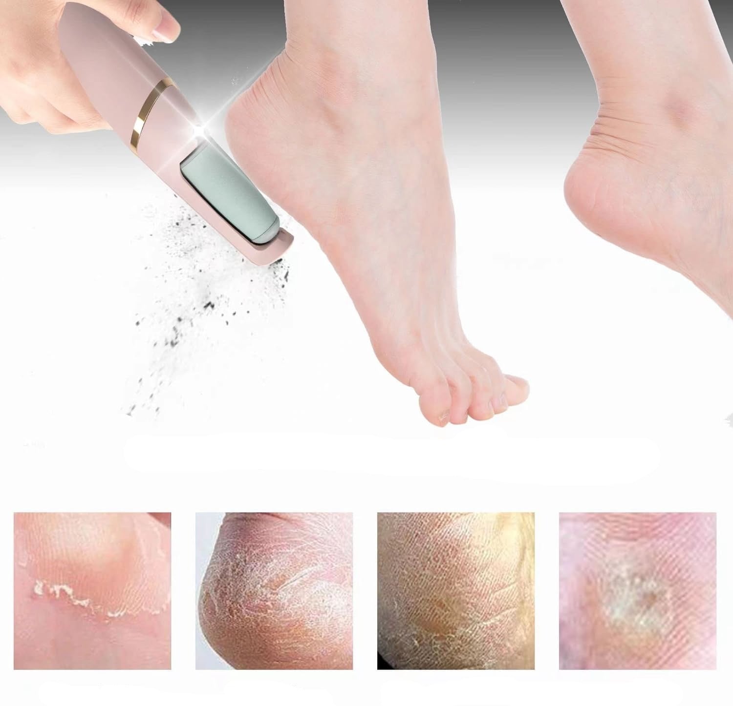 Mevor | Callus Removers - kompakt und sicher - schmerzlose Genesung-2