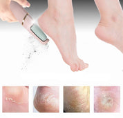 Mevor | Callus Removers - kompakt und sicher - schmerzlose Genesung-2