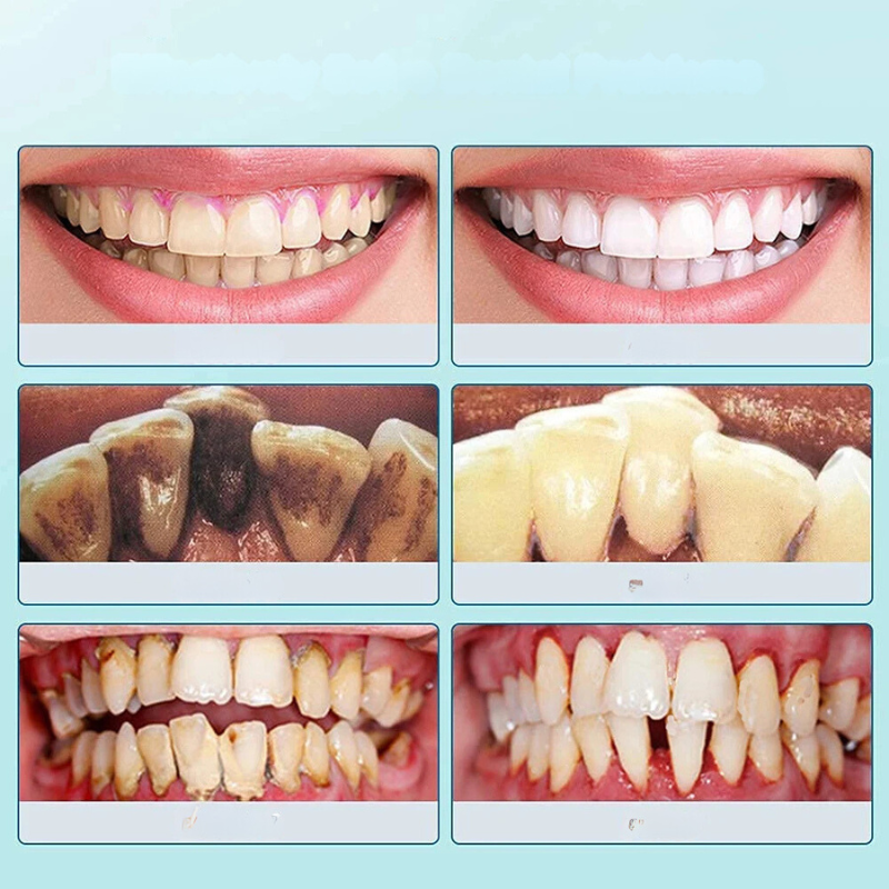 FreshScale - Ultraschall -Plaque & Tartar -Eliminator-3