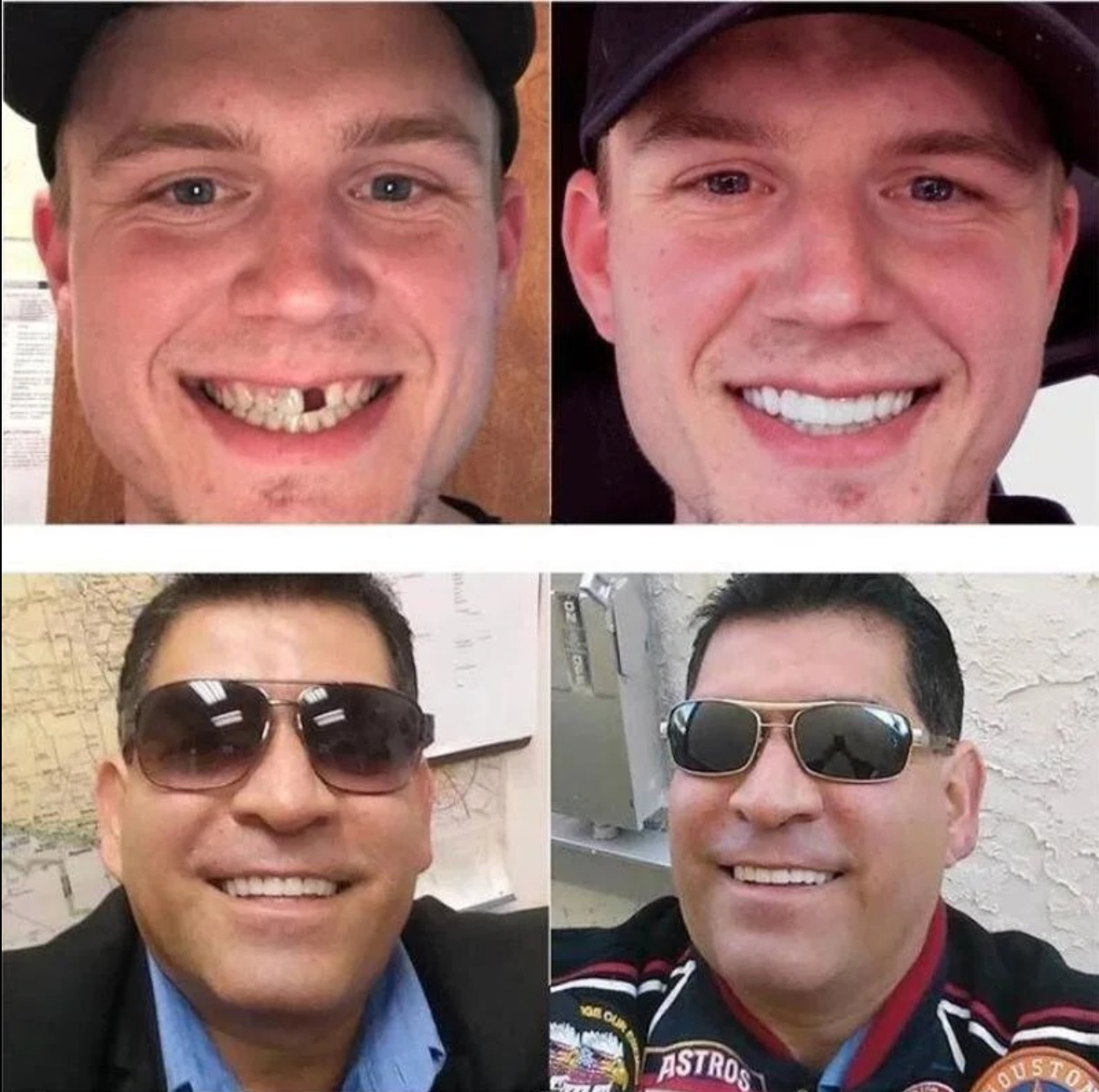 Verstellbare Snap-On-Zahnersatz 5